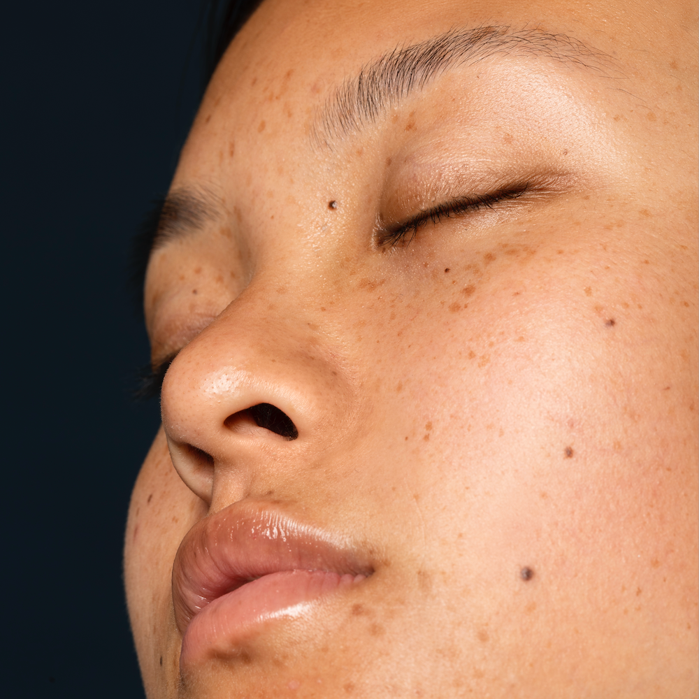 Anti-Dark Spot Facial 2 Sessions