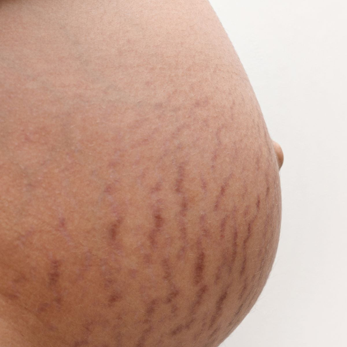 Microneedling for Stretch Marks 3 Sessions
