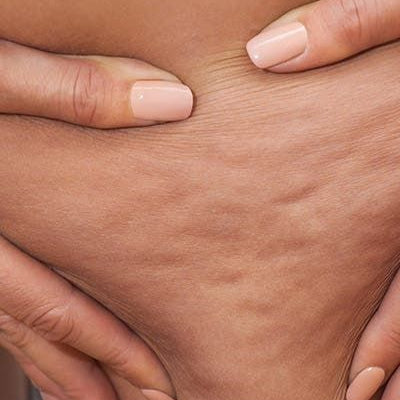 Venus Laser Body Sculpting Packages