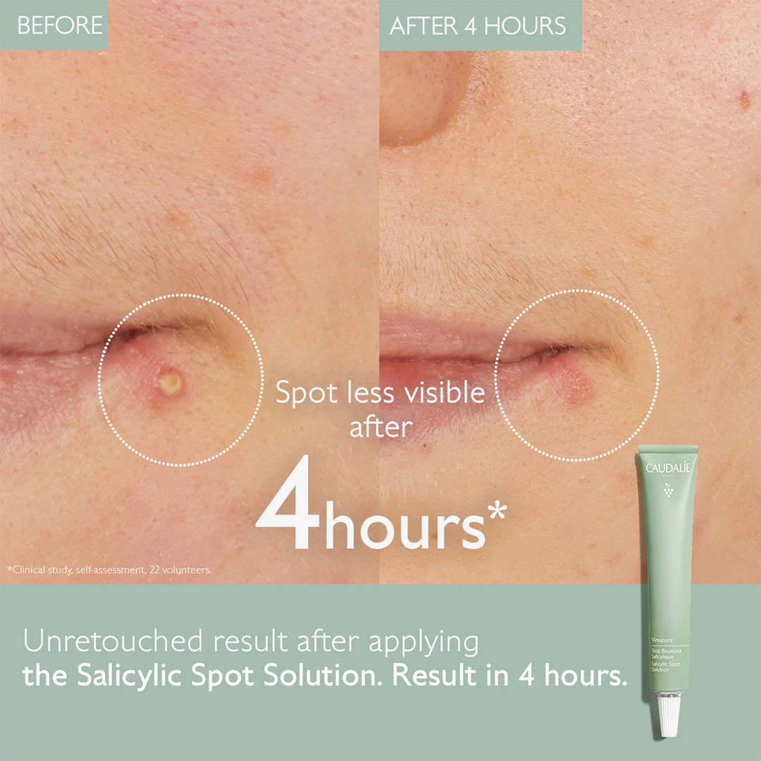 Vinopure Solution Ciblée (Acne Spot Treatment)